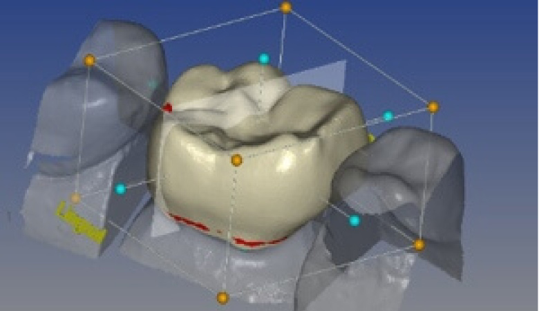 3D Crowns Printed in 10 Minutes Dental